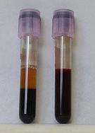 Valores normales de triglicéridos y colesterol en sangre